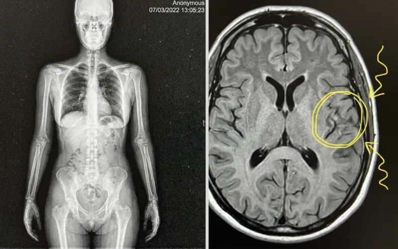 25W51 Sleep Apnea 2 Adaptation Story Asset 02